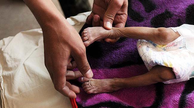 ​Названа можлива причина загибелі до 85 тисяч дітей в Ємені